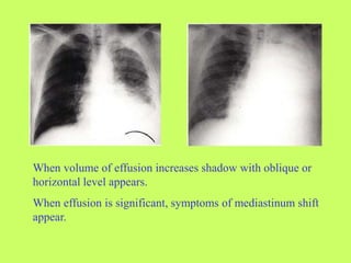When volume of effusion increases shadow with oblique or
horizontal level appears.
When effusion is significant, symptoms of mediastinum shift
appear.
 