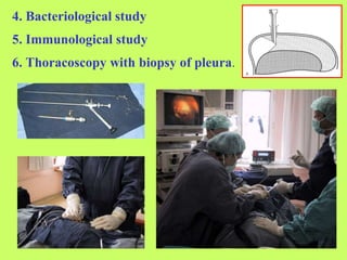 4. Bacteriological study
6. Thoracoscopy with biopsy of pleura.
5. Immunological study
 