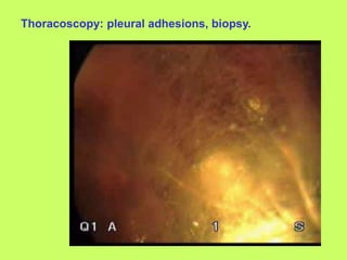 Thoracoscopy: pleural adhesions, biopsy.
 