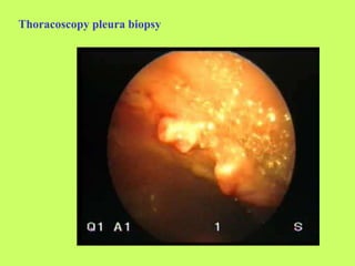 Thoracoscopy pleura biopsy
 