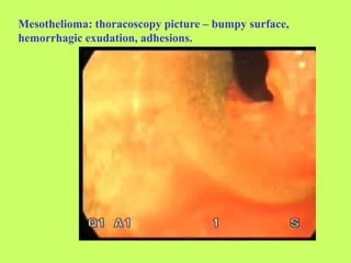 Mesothelioma: thoracoscopy picture – bumpy surface,
hemorrhagic exudation, adhesions.
 