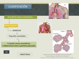 CLASIFICACIÓN
PLEURITIS SECA O PLÁSTICA.-
Pleura visceral
APARECEN
Pequeñas cantidades
Líquido seroso amarillento.
Adherencias entre superficies pleurales
Tb
FIBROTÓRAX Apuntes de Anatomía Patológica General y Especial
Desarrollados por Estudiantes de Medicina
Robbins y Cotran. Patología estructural y funcional. 6ª edición
 