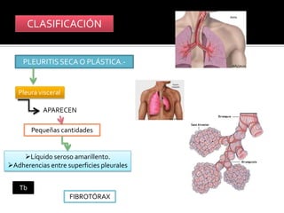 CLASIFICACIÓN


     PLEURITIS SECA O PLÁSTICA.-


   Pleura visceral

           APARECEN

        Pequeñas cantidades


    Líquido seroso amarillento.
Adherencias entre superficies pleurales


   Tb
                     FIBROTÓRAX
 