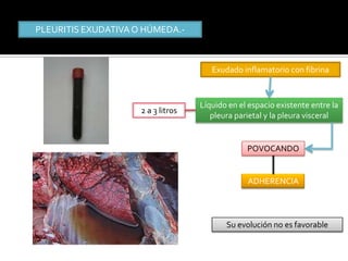 PLEURITIS EXUDATIVA O HÚMEDA.-



                                       Exudado inflamatorio con fibrina



                                    Líquido en el espacio existente entre la
                     2 a 3 litros
                                       pleura parietal y la pleura visceral


                                                 POVOCANDO


                                                 ADHERENCIA




                                           Su evolución no es favorable
 