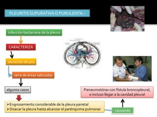PLEURITIS SUPURATIVA O PURULENTA.-



infección bacteriana de la pleura


 CARACTERIZA


secreción de pus


    serie de áreas tabicadas


algunos casos                                Pieneumotórax con fístula broncopleural,
                                                o incluso llegar a la cavidad pleural

Engrosamiento considerable de la pleura parietal
Disecar la pleura hasta alcanzar el parénquima pulmonar       causando
 