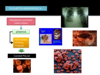 PLEURITIS HEMORRÁGICA.-



Neoplasias y procesos
   tuberculosos


     presencia


    Eritrocitos.
    Fibrina.
    Líquido



   Cavidad Pleural
 