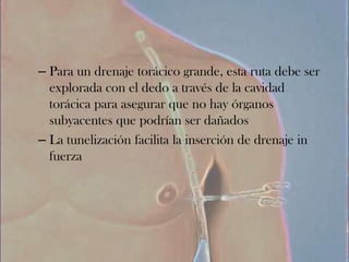 – Para un drenaje torácico grande, esta ruta debe ser
  explorada con el dedo a través de la cavidad
  torácica para asegurar que no hay órganos
  subyacentes que podrían ser dañados
– La tunelización facilita la inserción de drenaje in
  fuerza
 