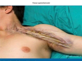Fossa supraclavicular
 