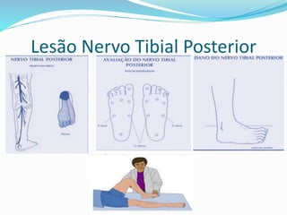Lesão Nervo Tibial Posterior
 