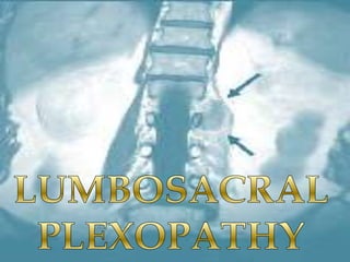 Plexopathy