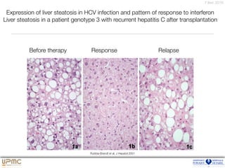 7 févr. 2016
Expression of liver steatosis in HCV infection and pattern of response to interferon
Liver steatosis in a patient genotype 3 with recurrent hepatitis C after transplantation
Rubbia-Brandt et al, J Hepatol 2001
Before therapy Response Relapse
 