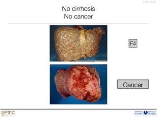 7 févr. 2016
Cancer
F4
No cirrhosis
No cancer
 
