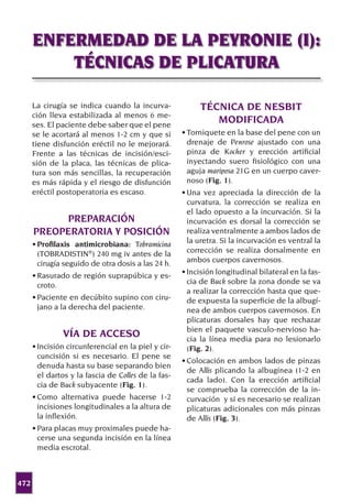 472
ENFERMEDAD DE LA PEYRONIE (I):
TÉCNICAS DE PLICATURA
La cirugía se indica cuando la incurva-
ción lleva estabilizada al menos 6 me-
ses. El paciente debe saber que el pene
se le acortará al menos 1-2 cm y que si
tiene disfunción eréctil no le mejorará.
Frente a las técnicas de incisión/esci-
sión de la placa, las técnicas de plica-
tura son más sencillas, la recuperación
es más rápida y el riesgo de disfunción
eréctil postoperatoria es escaso.
PREPARACIÓN	
PREOPERATORIA Y POSICIÓN
•	Profilaxis antimicrobiana: Tobramicina
(TOBRADISTIN
) 240 mg iv antes de la
cirugía seguido de otra dosis a las 24 h.
•	Rasurado de región suprapúbica y es-
croto.
•	Paciente en decúbito supino con ciru-
jano a la derecha del paciente.
VÍA DE ACCESO
•	Incisión circunferencial en la piel y cir-
cuncisión si es necesario. El pene se
denuda hasta su base separando bien
el dartos y la fascia de Colles de la fas-
cia de Buck subyacente (Fig. 1).
•	Como alternativa puede hacerse 1-2
incisiones longitudinales a la altura de
la inflexión.
•	Para placas muy proximales puede ha-
cerse una segunda incisión en la línea
media escrotal.
TÉCNICA DE NESBIT	
MODIFICADA
•	Torniquete en la base del pene con un
drenaje de Penrose ajustado con una
pinza de Kocher y erección artificial
inyectando suero fisiológico con una
aguja mariposa 21G en un cuerpo caver-
noso (Fig. 1).
•	Una vez apreciada la dirección de la
curvatura, la corrección se realiza en
el lado opuesto a la incurvación. Si la
incurvación es dorsal la corrección se
realiza ventralmente a ambos lados de
la uretra. Si la incurvación es ventral la
corrección se realiza dorsalmente en
ambos cuerpos cavernosos.
•	Incisión longitudinal bilateral en la fas-
cia de Buck sobre la zona donde se va
a realizar la corrección hasta que que-
de expuesta la superficie de la albugí-
nea de ambos cuerpos cavernosos. En
plicaturas dorsales hay que rechazar
bien el paquete vasculo-nervioso ha-
cia la línea media para no lesionarlo
(Fig. 2).
•	Colocación en ambos lados de pinzas
de Allis plicando la albugínea (1-2 en
cada lado). Con la erección artificial
se comprueba la corrección de la in-
curvación y si es necesario se realizan
plicaturas adicionales con más pinzas
de Allis (Fig. 3).
 