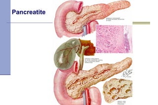 Pancreatite 