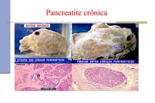 Pancreatite crônica 