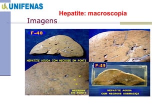 Hepatite: macroscopia Imagens 