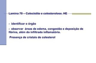 Lamina 70 – Colecistite e colesterolose. HE   -  identificar o órgão  -  observar  áreas de edema, congestão e deposição de fibrina, além do infiltrado inflamatório. Presença de cristais de colesterol  