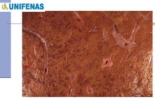 Necrose hepática aguda 