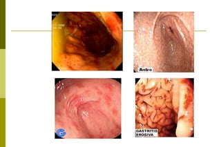 Gastrite crônica:Tem início insidioso, de evolução lenta e gradativa ao longo de anos ou décadas. São assintomáticos ou oligossintomáticos. O diagnóstico histológico da gastrite crônica se baseia na presença da reação inflamatória na mucosa caracterizada por exsudato de mono e polimorfonucleares, em proporção e intensidade variáveis