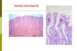 Classificação das gastrites crônicas:Gastrite antral(tipo B) tem etiologia bacteriana (H. pylori). Gastrite do corpo (tipo A) etiologia auto-imune (desenvolvimento de Ac contra células parietais). Atinge a mucosa oxíntica e pode evoluir rápido para atrofia. A mucosa do antro parece normal. Pangastrite (tipo AB) também de etiologia bacteriana."Diferentes cepas associadas as diferentes reações do hospedeiro levam a instalação de um dos tipos ". Têm maior tendência ao aparecimento de alterações do crescimento e diferenciação celular do epitélio glandular do que aqueles com gastrite somente antral. 