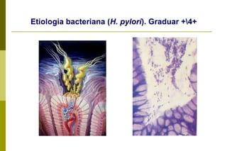 Gastrite antral(tipo B)