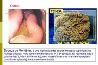Etiologia bacteriana (H. pylori). Graduar +\4+