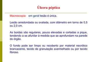 Outros:Doença de Ménétrier: é uma hiperplasia das células mucosas superficiais da mucosa gástrica, mais comum em homens na 4a à 6a décadas. Na realidade, não é gastrite (isto é, não há inflamação), nem hipertrófica (o que há é uma hiperplasia das células epiteliais). A causa é desconhecida