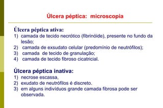 Úlcera pépticaMacroscopia: em gerallesão é única. Lesão arredondada ou ovalada, com diâmetro em torno de 0,5 ou 2,0 cm.As bordas são regulares, pouco elevadas e cortadas a pique, tendendo a se afunilar à medida que se aprofundam na parede do órgão. O fundo pode ser limpo ou recoberto por material necrótico brancacento, tecido de granulação avermelhado ou por tecido fibroso. 