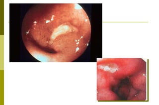 Úlcera péptica:  microscopia Úlcera péptica ativa: camada de tecido necrótico (fibrinóide), presente no fundo da lesão; camada de exsudato celular (predomínio de neutrófilos);  camada  de tecido de granulação;  camada de tecido fibroso cicatricial. Úlcera péptica inativa:necrose escassa,exudatode neutrófilos é discreto.em alguns indivíduos grande camada fibrosa pode ser observada.