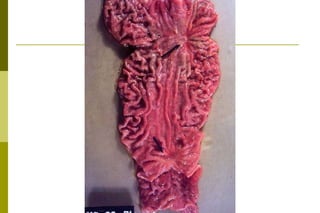 Úlcera péptica: conseqüências e complicações:A hemorragia é a mais comum (discretas ou maciça com hematêmase ou melena). Pode ocorrer perfuração com formação de aderências (pela peritonite). Estenoses e/ou deformações do órgãoCancerização?. 