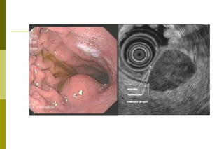 Tumores de estômagoLesões/Condições pré-cancerosas:Adenomas ou pólipos adenomatosos Dieta : nitratos (conservante alimentar), nitritos, benzopireno (carne defumada). A produção interna de nitrosaminas é inibida pelas vitaminas C e E. Metaplasia intestinal e displasia gástrica ( pangastrite; gastrite crônica atrófica do corpo/ anemia perniciosa: adenomas e presença de nódulos hiperplásicos constituídos por células argirófilas). Gastrectomia : úlcera da boca anastomótica (aparecem de 15-20 anos depois). H. pylori (polêmico: somente algumas cepas e em certos ambientes). Doença de Ménètrier  Câncer "in situ" Úlcera péptica gástricas
