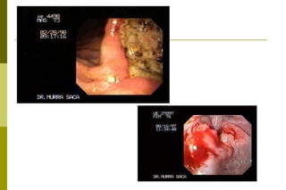 Tumores do estômagoPrecoce (incipiente):