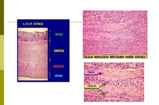 Tem bom prognóstico (sobrevida de 5 anos para 99% Ca restrito a mucosa e 95% quando atinge submucosa). Microscopicamente:  diferenciado (estrutura de adenocarcinoma tubular e está relacionado com áreas de metaplasia intestinal), 