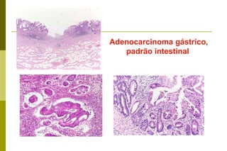  indiferenciado. Localizaçã: mais freqüente no antro na pequena curvatura. 