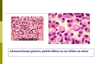 Tumores de estômago: macroscopia:Avançado:-Atinge a muscular e pode chegar a serosa - Sobrevida de 5 anos de 50-70% se infiltrou até a muscular e de 8-20% se acomete serosa. Tipos: nodular, vegetante ou polipóide;