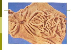  glândulas intestinais e vacúolos de mucina.tipo difuso:infiltrativo, sem formar glândulas em agrupamentos. 