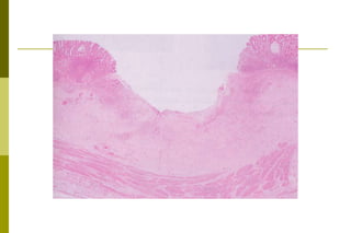  ocorre formação de cordões celulares.