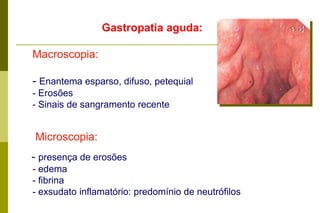 Gastropatia aguda: Macroscopia:Enantema esparso, difuso, petequial