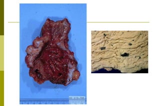 Sinais de sangramento recenteMicroscopia:         - presença de erosões edema