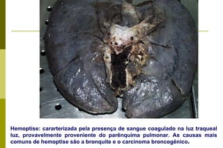 Hemoptise: cararterizada pela presença de sangue coagulado na luz traqueal luz, provavelmente proveniente do parênquima pulmonar. As causas mais comuns de hemoptise são a bronquite e o carcinoma broncogênico . 