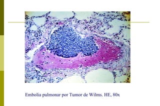 Embolia pulmonar por Tumor de Wilms. HE, 80x  