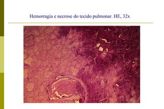 Hemorragia e necrose do tecido pulmonar. HE, 32x  
