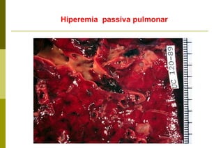 Hiperemia  passiva pulmonar 