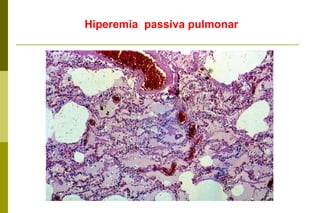 Hiperemia  passiva pulmonar 