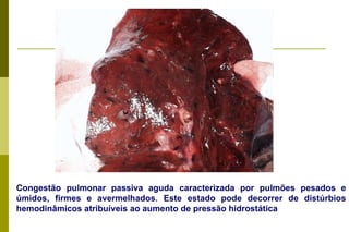 Congestão pulmonar passiva aguda caracterizada por pulmões pesados e úmidos, firmes e avermelhados. Este estado pode decorrer de distúrbios hemodinâmicos atribuíveis ao aumento de pressão hidrostática 