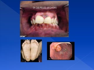 SX DE PEUTZ-JEGHERS
 