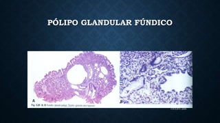 CICLIPA 2006
PÓLIPO GLANDULAR FÚNDICO
 