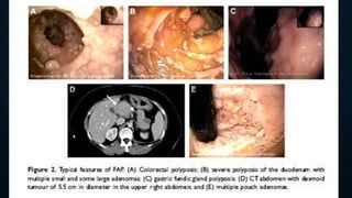 POLIPOSIS ADENOMATOSA
FAMILIAR
• Trastorno hereditario autosomico dominante. Penetrancia del 100%.
• 80% hay antecedentes familiares.
• 10-30% mutaciones nuevas.
• 1/10000 nacidos vivos.
• Edad promedio en detectar los pólipos es 15 años.
• 15% evidencia de pólipos a los 10 años.
• 75% evidencia a los 20 años.
• 90% evidencia a los 30 años.
• El CG. Aparece en promedio a los 35 años.
 