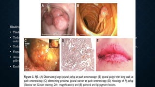 SÍNDROMES POLIPOSICOS
HAMARTOMATOSOS
Síndrome de Peutz-Jeghers:
• Tratamiento:
• Todos los pólipos > a 5mm deben ser removidos endoscópicamente (tanto gástricos como
colo-rectales).
• Todo pólipo mayor de 15 mm en el intestino delgado debe ser removido quirúrgicamente.
• Seguimiento:
• Anualmente con hemograma, examen ginecológico y mamario, papanicolao, ecografía
pélvica, testicular y abdominal.
• Endoscopía alta y baja deben ser realizadas cada dos años.
 