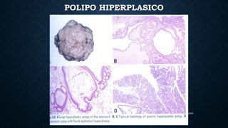 CICLIPA 2006
POLIPO HIPERPLASICO
 